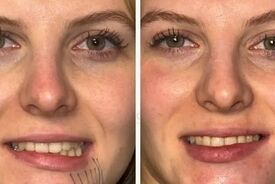 افتادگی ناگهانی صورت؛ نشانه‌ای که می‌تواند از سکته مغزی خبر دهد
